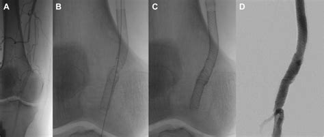 Endovascular Treatment Of Popliteal Artery Occlusion Caused By A