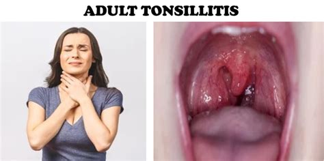 ADULT TONSILLITIS: Symptoms, Diagnosis, Treatment, and Care