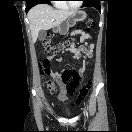 Traumatic Small Bowel And Mesenteric Injury Radiology Case