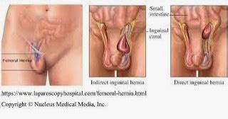 Useful Information What You Need To Know About Femoral Hernias