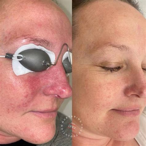 New Rosacea Treatment 2025 Billi Cherise