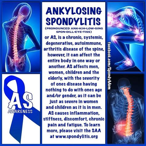 Learn More About As By Visiting Stopas Org Arthritis In Back