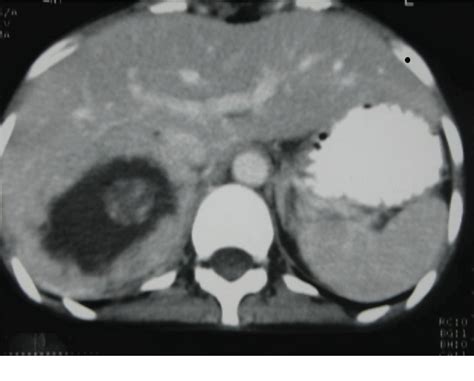 Figure 1 From Adrenal Cortical Carcinoma Masquerading As Pheochromocytoma A Case Report