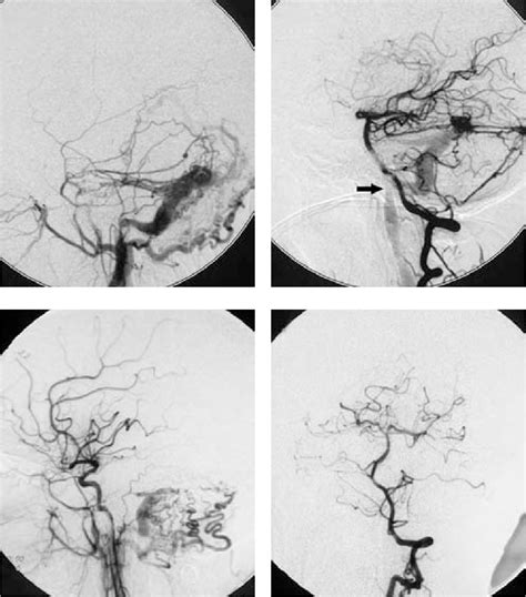 Figure From Onyx Distal Embolization In Transarterial Embolization Of