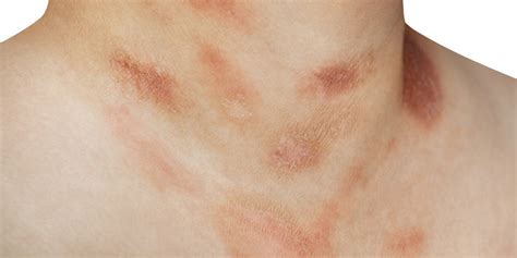 Red Dots On Skin Rash