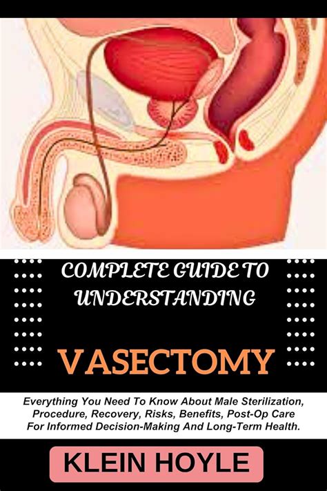 COMPLETE GUIDE TO UNDERSTANDING VASECTOMY Everything You Need To Know