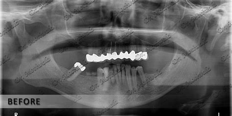 Do You Have Dental Bone Graft Cost and its Complications