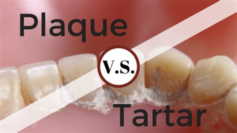 plaque  tartar whats  difference britt dental center