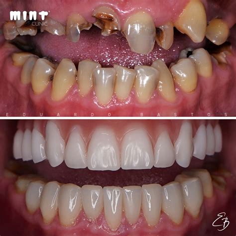 Zirconia Crowns Treatment Affordable Dental Veneers In Turkey Artofit