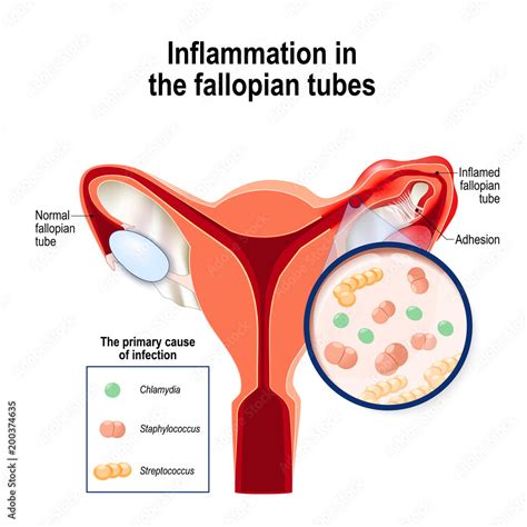 Inflammation In The Fallopian Tubes And Primary Cause Of Infection Stock Vector Adobe Stock