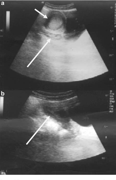 Unicornuate Uterus With An Obstructed Rudimentary Horn A Report Of Two