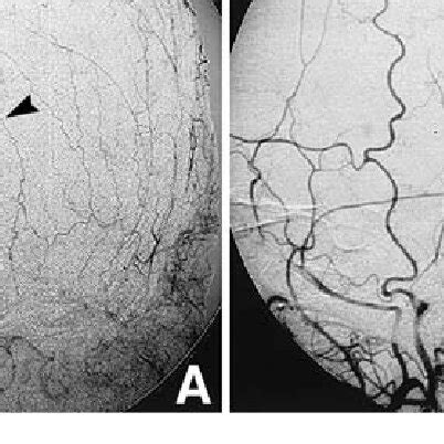 Anteroposterior A And Lateral B Selective Left External Carotid