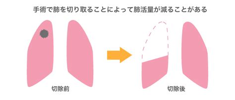 医師監修・作成 肺腺がんとは？原因、症状、検査、治療について Medleyメドレー