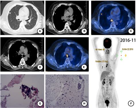 PET CT Scan November 2016 And Histopathological Results After