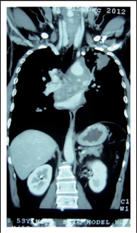 Figure 1 From Tuberculosis Presenting As Mediastinal And Lung Mass Radiologically A Case Report