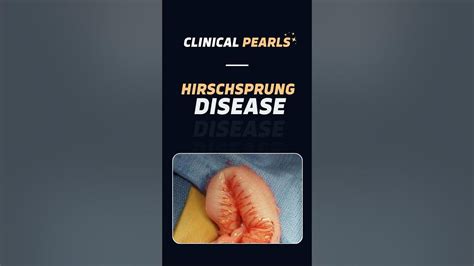 How To Identify Hirschsprung Disease Clinicalpearls 1 Youtube