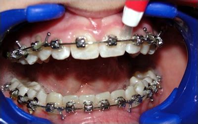 Sulcular & Interproximal Brushes - Ortho 101 for the Dental Professional - Dentalcare