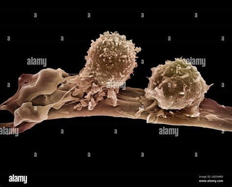 T Lymphocytes And Cancer Cell Coloured Scanning Electron Micrograph