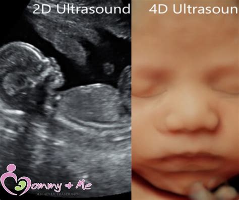 Week Ultrasound Unveiling The Benefits At Mommy And Me