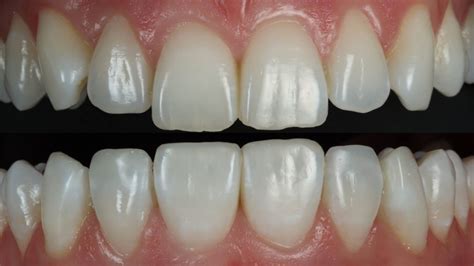 Composite Veneers Pros And Cons