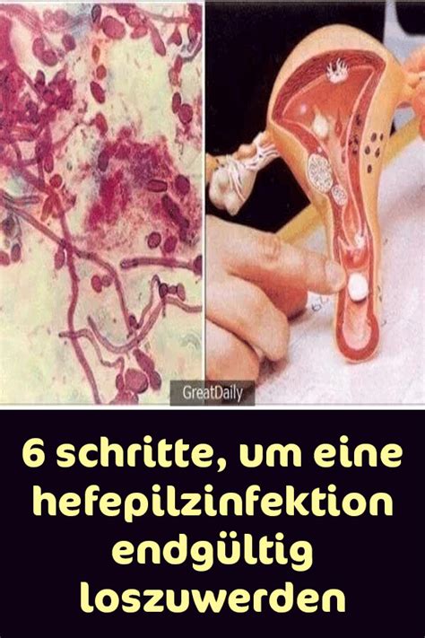 6 Schritte um eine Hefepilzinfektion endgültig loszuwerden Pilze