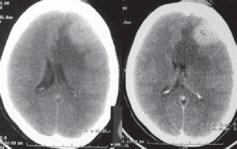 Axial Ct Images Showing Hyperdense Lesion On Plain Scan Left Left Download Scientific Diagram