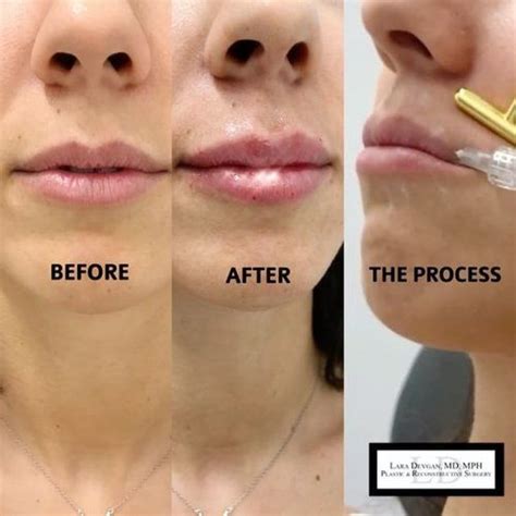 Dermapen Microneedling Also Called Collagen Induction Therapy Is A