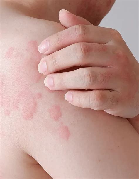 Itchy Skin Hives