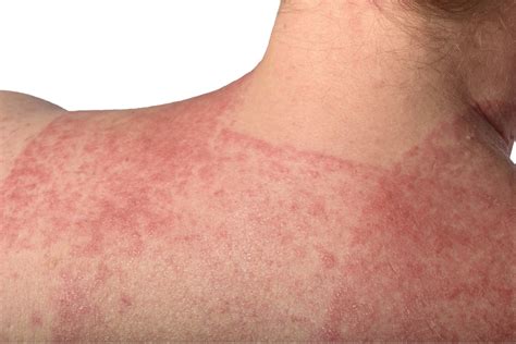 A Comprehensive Guide To Contact Dermatitis From Sunscreens Causes