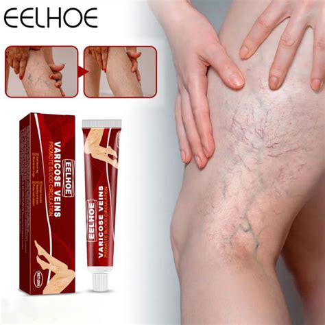 Eelhoe Varicose Vein Cream Venous Massage Ointment Earthworm Leg