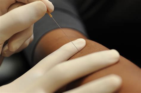 Dry Needling Effective Treatment For Myofascial Pain Washington