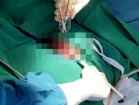Red Faced Bloke Has 7 Inch Dildo Removed From His Bum He Shoved There