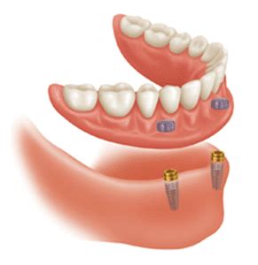 Snap on Dentures | Lindale Dentist: The Center for Implant & General ...