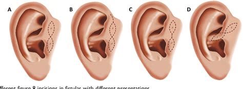 Figure 3 From Decision Making In The Choice Of Surgical Management For