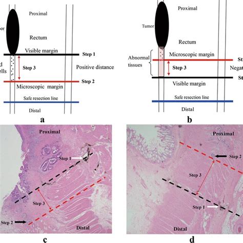 Labeling Of The Tumor Visible Margin With Naked Eyes A Visible Tumor