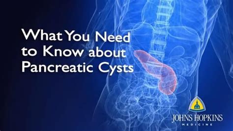 What You Need To Know About Pancreatic Cysts Johns Hopkins Medicine