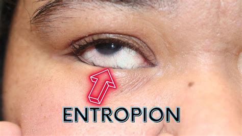 Entropion Dr Anthony Maloof