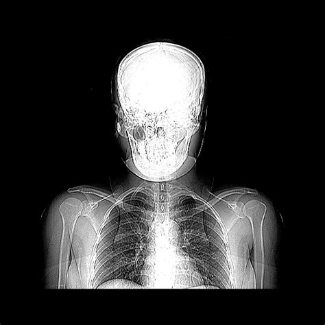 Cervical Rib Image