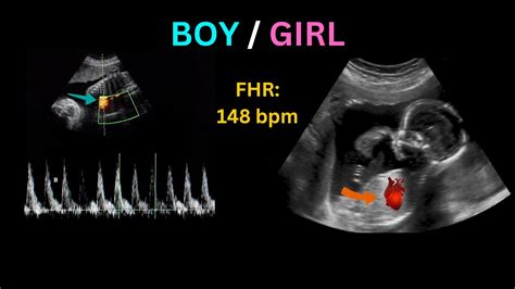 Heartbeat Ultrasound Boy Or Girl Gender Prediction Fetal Heartbeat Sound Youtube