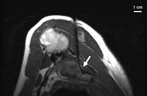 Closed Bore Interventional Mri Percutaneous Biopsies And Ablations Ajr