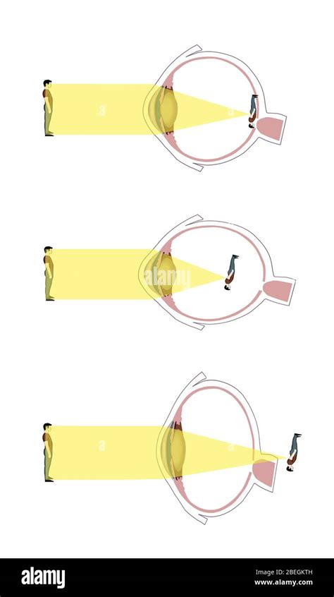 normal nearsighted  farsighted vision stock photo alamy