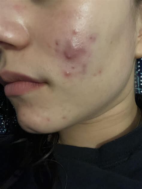 Deep cystic acne for two years same spot even with medication : r/acne