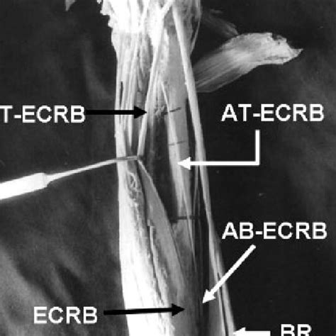 Additional Belly Of Extensor Carpi Radialis Brevis Ab Ecrb Can Be Download Scientific Diagram