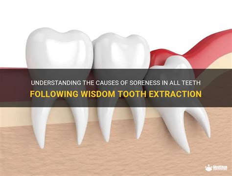 Understanding The Causes Of Soreness In All Teeth Following Wisdom