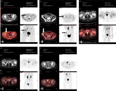 Nivolumab And Dinutuximab Beta In Two Patients With Refractory