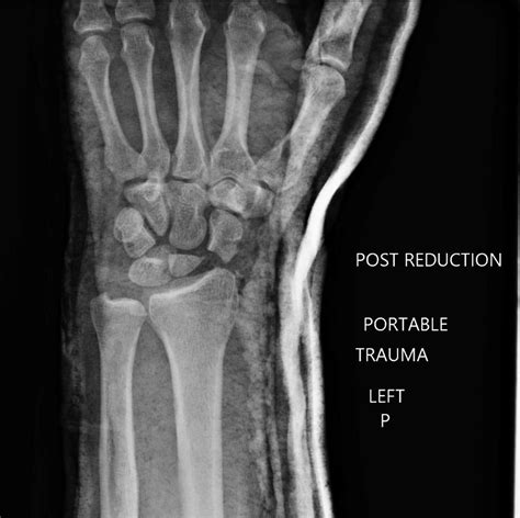 Wrist Dislocation After Motorcycle Crash Sports Medicine Review