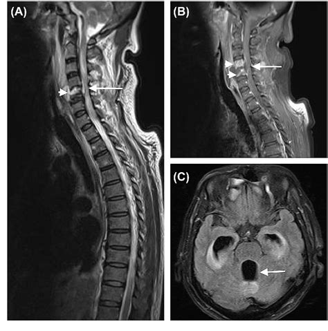 Figure From A Rare Complication Of Cervical Spinal Epidural Abscess