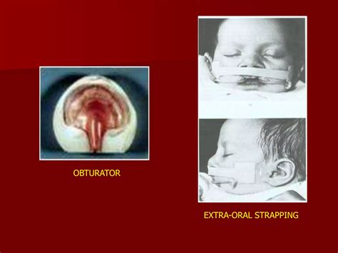 Cleft Lip And Palate Ppt