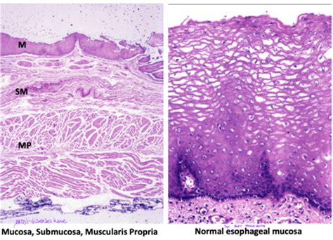 Unit 5 Gi Pathology Flashcards Quizlet