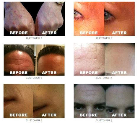 Nerium Before And After Pictures Anazoe Derma Spa And Tanning